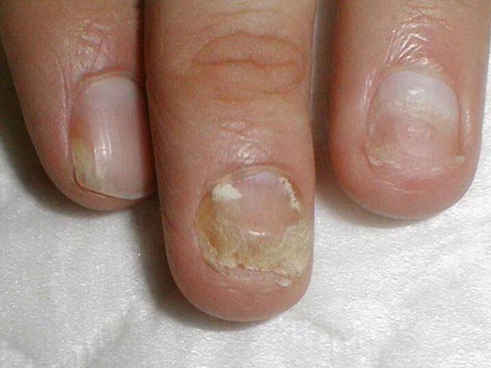 Liječenje gljivice na noktima kandide