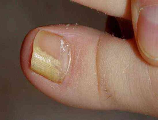 distalni bočni oblik gljivice na noktima
