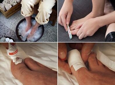 Naparevanje stopala i nanošenje kreme od uree na nokte pogođene gljivicama