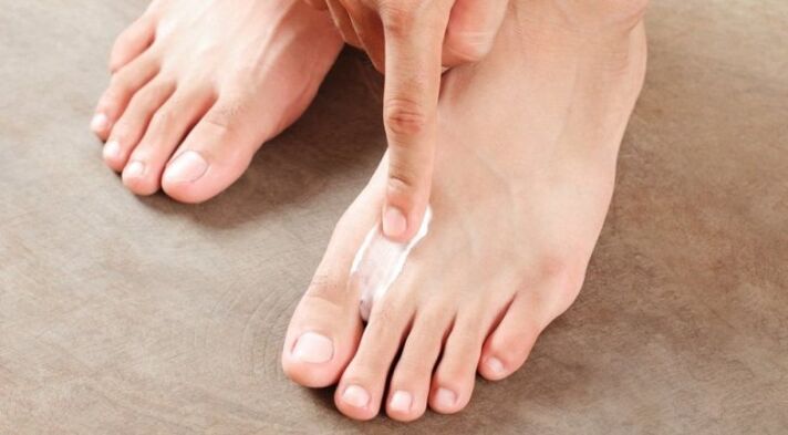 kako i kako liječiti gljivice između prstiju na nogama