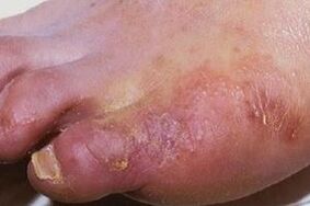 manifestacije gljivične infekcije na koži nogu