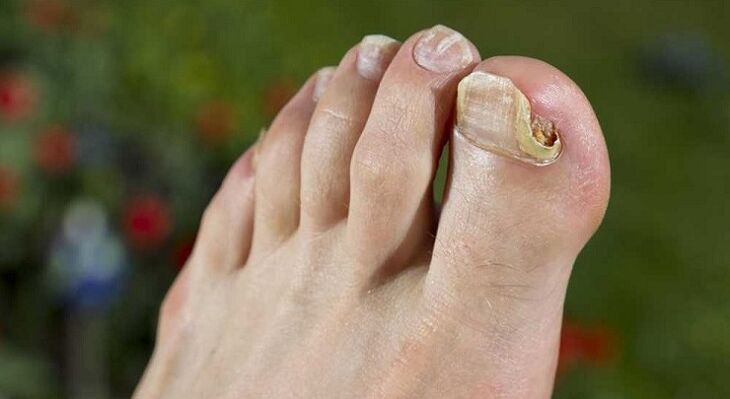 oštećenje nokatne ploče gljivicama na nogama
