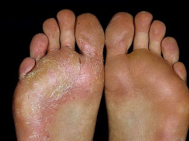 simptomi gljivice na stopalu