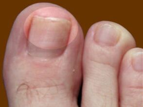 Gljivice na noktima na nogama - indikacija za upotrebu fungicidnih kapi