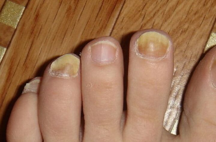 simptomi gljivica na noktima i koži stopala