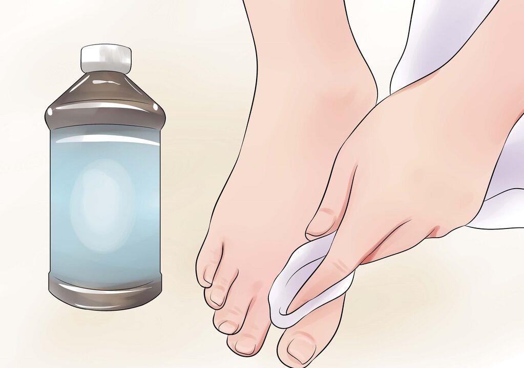 vodikov peroksid za gljivice na noktima na nogama