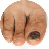 kako liječiti gljivicu noktiju na nogama