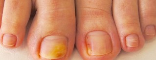 gljivice nokte simptome