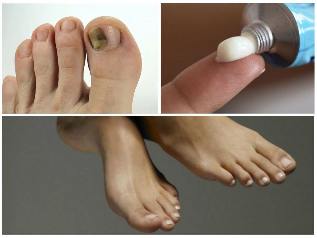 gljivice za nokte tretman