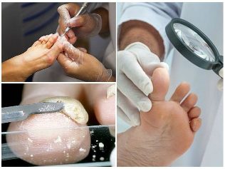 gljivice nogu kožu dijagnozu