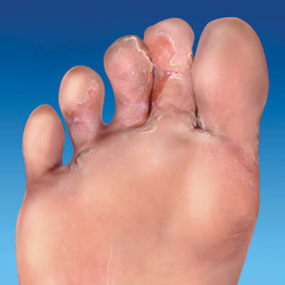 koža gljivice stopala